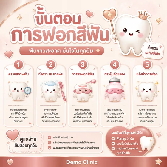 โพสต์คลินิกทันตกรรม อธิบายขั้นตอนการฟอกสีฟัน 5 ขั้น